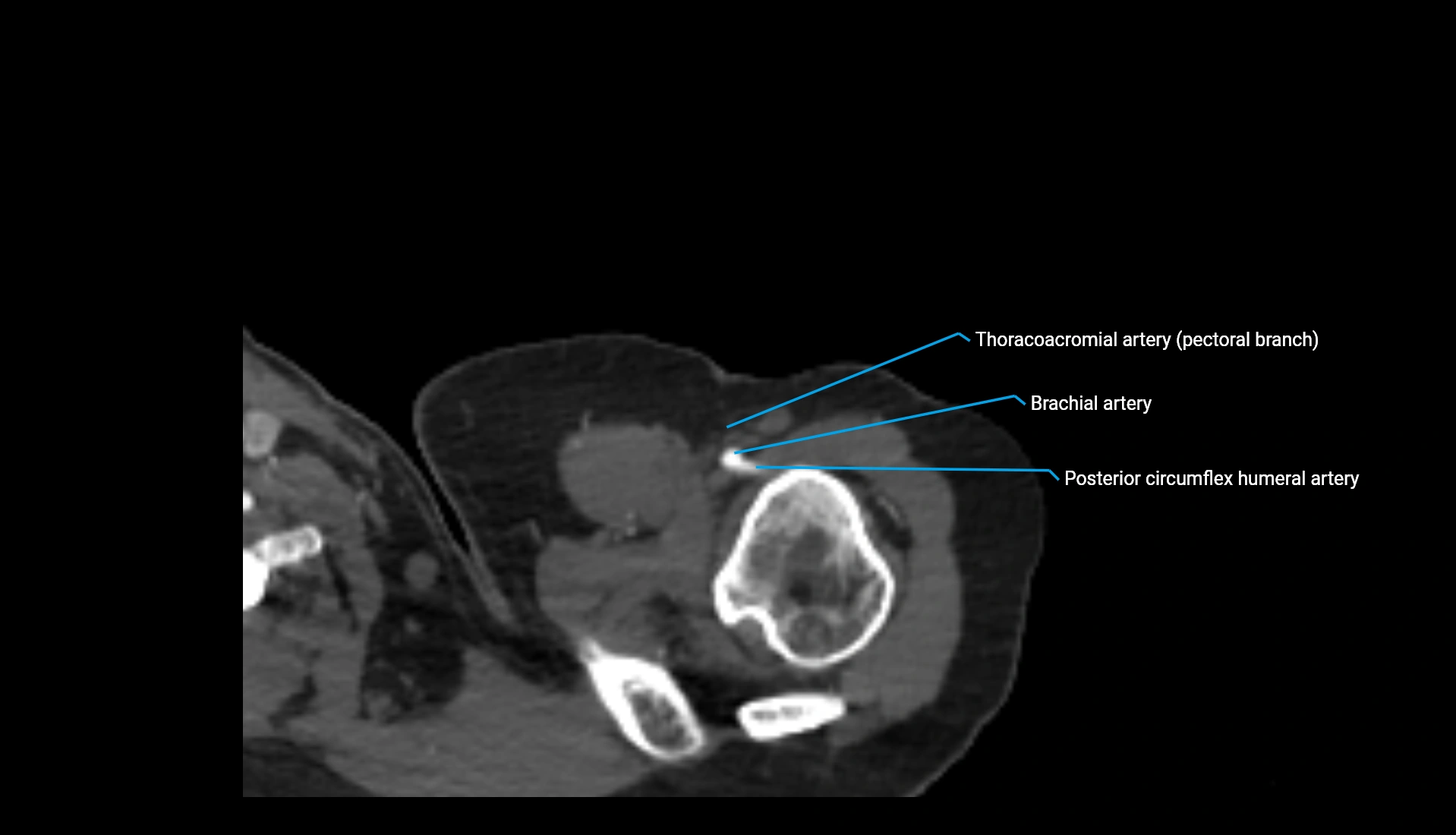 CTA upper limb axial cross sectional anatomy labelled image 319 (1).webp